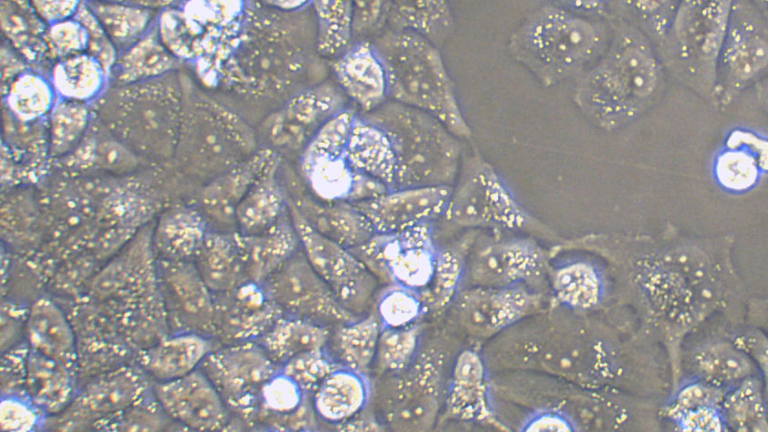 AN3 CA人子宫内膜腺癌(转移)细胞